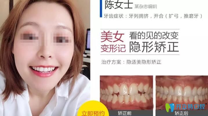 無(wú)錫北極星口腔隱適美隱形矯正案例 無(wú)錫北極星口腔隱適美隱形矯正案例