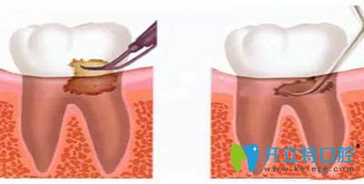 洗牙和齦下刮治可以一起做嗎？看洗牙和刮治的區(qū)別在哪里