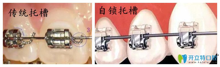 什么是自鎖托槽矯正技術(shù)