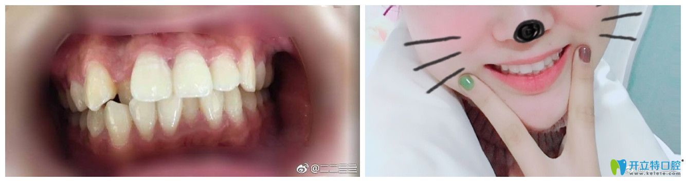 北京中諾口腔孫金鑫牙齒矯正好不好？案例效果來證明