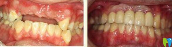 孫金鑫牙齒種植案例效果對(duì)比圖