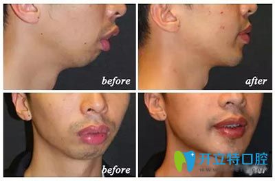 下巴后縮矯正前后對比圖