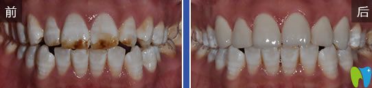 圣貝口腔氟斑牙美學(xué)貼面前后對(duì)比圖 圣貝口腔氟斑牙美學(xué)貼面前后對(duì)比圖