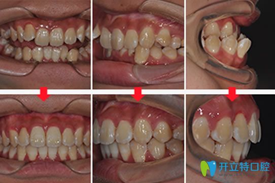 廣州圣貝口腔自鎖托槽牙齒矯正案例 廣州圣貝口腔自鎖托槽牙齒矯正案例