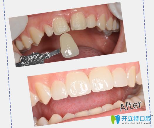 廣州圣貝口腔蔡菁菁醫(yī)生牙齒貼面案例 廣州圣貝口腔蔡菁菁醫(yī)生牙齒貼面案例