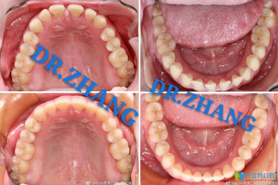 杭州美奧口腔張彼得主任正畸比對圖