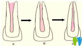 解答什么叫根尖誘導(dǎo)成形術(shù),及兒童做牙根尖誘導(dǎo)是否有風(fēng)險(xiǎn)