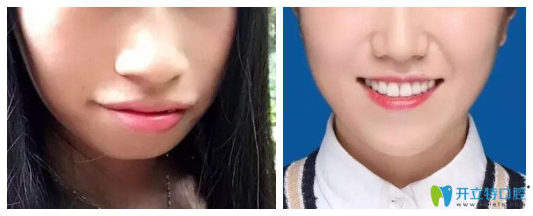 牙齒正畸對臉型的影響？看牙齒矯正案例效果前后對比圖