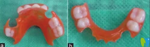 間隙保持器的種類有哪些