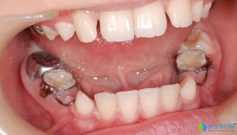 牙間隙保持器價格1000貴嗎？兒童間隙保持器不做行不行？