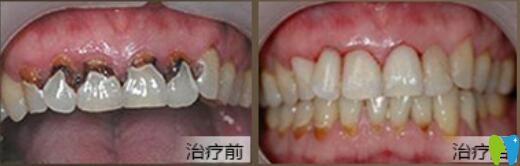 北京中諾口腔好不好？郭祖迎牙齒修復案例效果來驗證