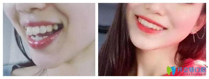 牙齒矯正能改變臉型嗎？看維樂口腔<!--<i data=20240703-sp></i>-->齙牙矯正前后對比圖