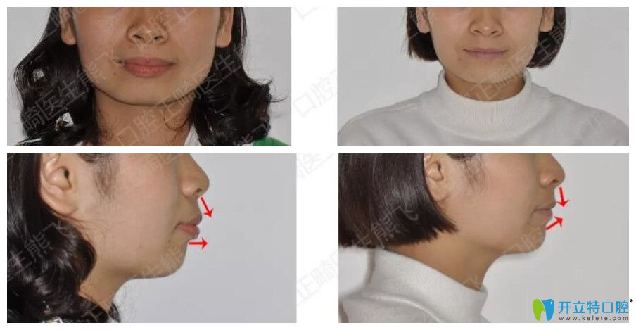 圣貝口腔正畸怎么樣？來(lái)看熊飛突嘴齙牙矯正案例前后效果對(duì)比