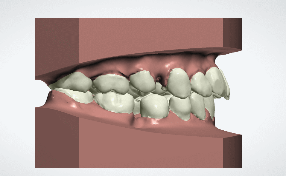 牙齒矯正移動圖