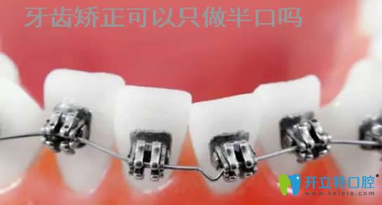 牙齒矯正可以只做半口嗎