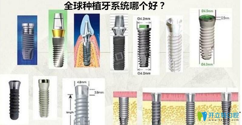 種植牙系統(tǒng)哪個好？來看世界種植體排名詳情及價格表