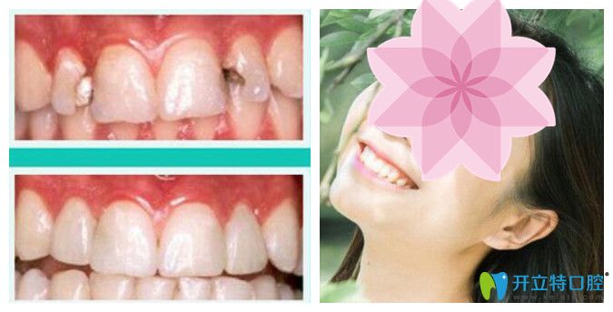 北京中諾口腔張勝民牙齒修復(fù)怎么樣？真實(shí)案例效果公布