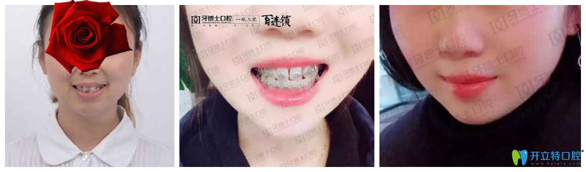 重慶成佳牙博士怎么樣，坑人嗎？看牙博士口腔醫(yī)生矯正真人案例