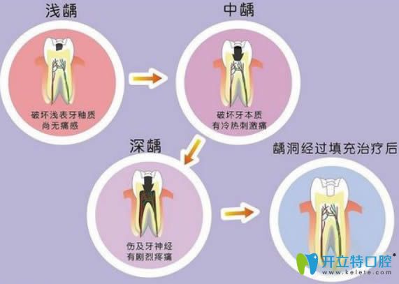 蛀牙如何讓它停止腐蝕