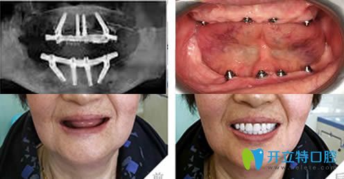 沈陽歡樂仁愛口腔全口牙種植對比圖