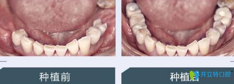 北京中諾趙振宇多顆牙缺失種植案例