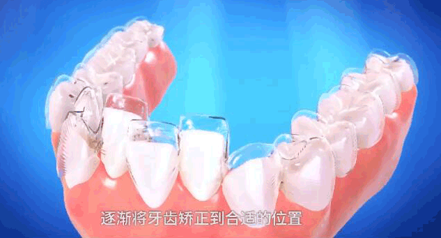 重慶成佳牙博士好不好呢，牙齒矯正效果來預(yù)見