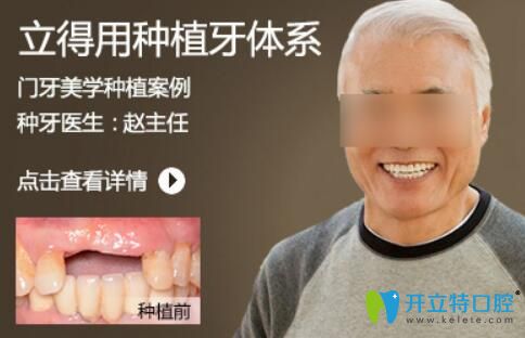 北京中諾趙振宇種植牙怎么樣？案例及顧客反饋來看