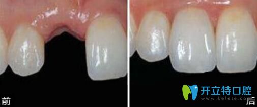 深圳拜爾口腔種植牙真人案例前后效果對比