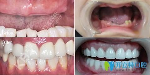 沈陽康貝佳口腔半口和全口牙種植圖