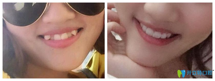 有虎牙能做矯正嗎？看重慶牙博士口腔虎牙隱形矯正案例效果對比圖