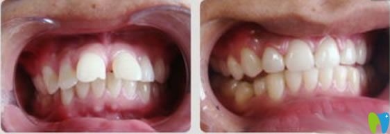 隱適美齙牙矯正前后對比圖 隱適美齙牙矯正前后對比圖