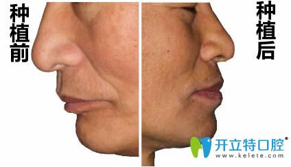 在洛陽拜博做完即刻種植牙前后對比照 在洛陽拜博做完即刻種植牙前后對比照