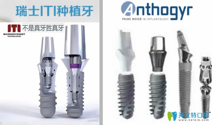 法國安卓健和瑞士iti種植體實(shí)物圖片