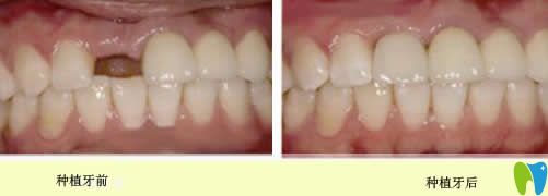單顆牙缺失種植前后對比圖