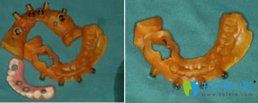 術(shù)中使用的導(dǎo)板 術(shù)中使用的導(dǎo)板