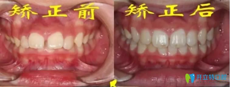 洛陽(yáng)拜博畢芳醫(yī)生MRC矯正案例對(duì)比照 洛陽(yáng)拜博畢芳醫(yī)生MRC矯正案例對(duì)比照