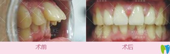 北京美萊口腔王凱主任齙牙矯正案例