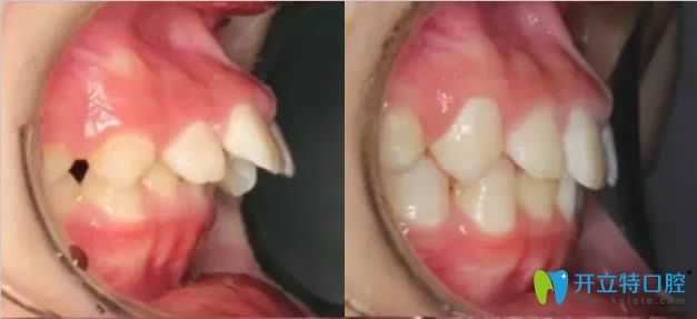 mrc矯正深覆合側(cè)顏前后對(duì)比圖 mrc矯正深覆合側(cè)顏前后對(duì)比圖
