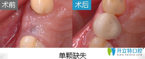 北京美萊口腔于英院長(zhǎng)即刻種植牙案例