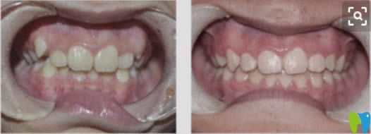 周驊醫(yī)生成人時(shí)代天使隱形矯正前后對(duì)比效果