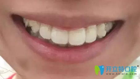 我在北京美萊整形口腔科做牙齒矯正第9個月 我在北京美萊整形口腔科做牙齒矯正第9個月