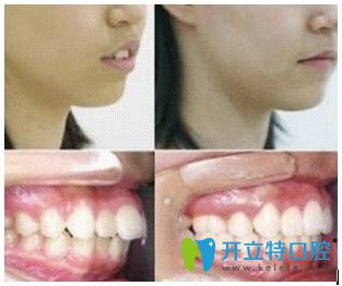 北京美萊口腔宋學志主任齙牙矯正前后對比圖