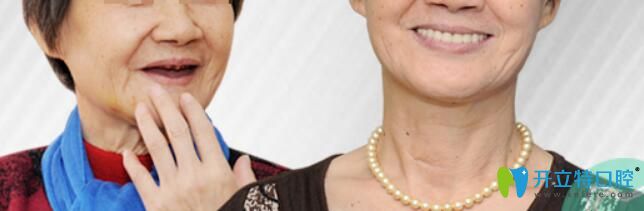 重慶種植牙哪家好？華美牙科全口牙種植案例效果對(duì)比一覽