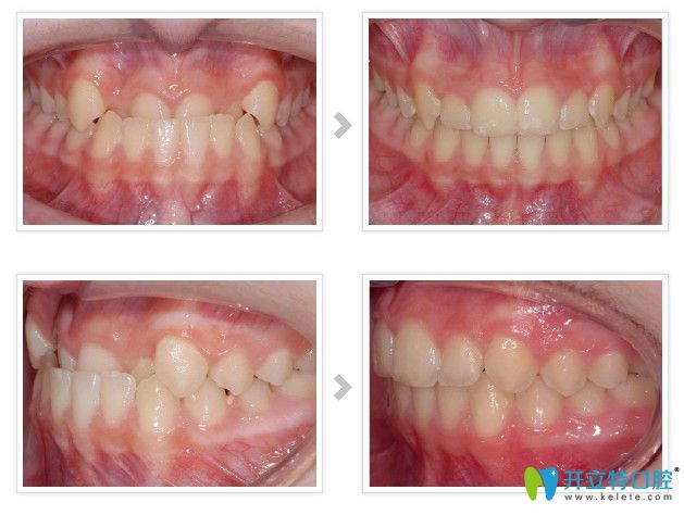 北京美萊口腔魏金忠主任地包天矯正案例