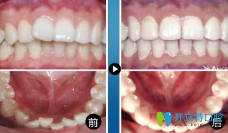重慶華美口腔王偉好不好？真人牙齒矯正案例效果公布