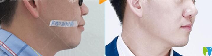 重慶牙齒矯正哪里好？重慶華美口腔吳承瓊牙齒半隱形矯正案例公布