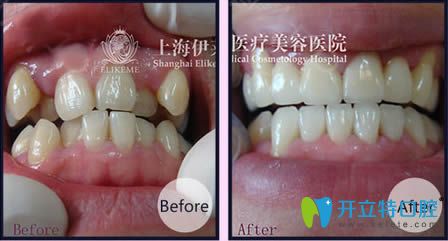 <!--<i data=20240703-sp></i>-->伊萊美王海鑫醫(yī)生虎牙矯正前后對(duì)比照