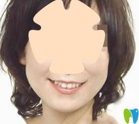 我在太原眾牙口腔做的人工種植牙術(shù)后照