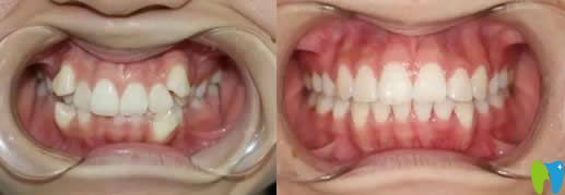 北京京通口腔科尚書虎牙隱形矯正案例