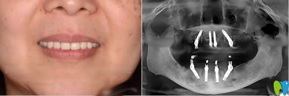 在<!--<i data=20240703-sp></i>-->宏康口腔做完全口種植牙的效果及全景圖